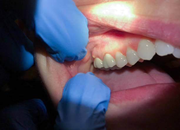 Best Knocked-Out Tooth (Avulsed Tooth) Treatment in , RI